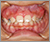 上顎前突症【出っ歯・混合歯列期】の症例6