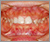 舌側矯正【舌側からの見えない治療】の症例5