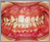 上顎前突症【出っ歯・永久歯列期】の症例12