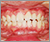 臼歯部交叉咬合【顔面非対称・永久歯列期】の症例4