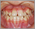 下顎前突症【受け口・永久歯列期】の症例5