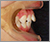 上下顎前突症【出っ歯】の症例6