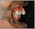 上顎前突症【出っ歯・永久歯列期】の症例15