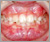 上顎前突症【出っ歯・混合歯列期】の症例7
