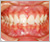 上顎前突症【出っ歯・永久歯列期】の症例16