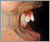 上顎前突症【出っ歯・混合歯列期】の症例8