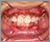 上顎前突症【出っ歯・混合歯列期】の症例9