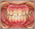 上下顎前突症【出っ歯】の症例7