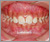 上顎前突症【出っ歯・混合歯列期】の症例10