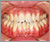 舌側矯正【舌側からの見えない治療】の症例7
