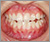 下顎前突症【受け口・混合歯列期】の症例6