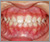 上顎前突症【出っ歯・混合歯列期】の症例11
