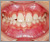 先天性欠如歯【永久歯の先天性欠如】の症例5