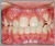 臼歯部交叉咬合【顔面非対称・永久歯列期】の症例5