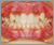 先天性欠如歯【永久歯の先天性欠如】の症例8