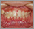 上顎前突症【出っ歯・永久歯列期】の症例18