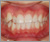 上下顎前突症【出っ歯】の症例9