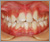 先天性欠如歯【永久歯の先天性欠如】の症例9
