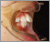 上顎前突症【出っ歯・混合歯列期】の症例14