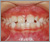 下顎前突症【受け口・混合歯列期】の症例7