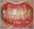 上顎前突症【出っ歯・永久歯列期】の症例20