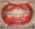 上顎前突症【出っ歯・混合歯列期】の症例15