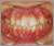 上顎前突症【出っ歯・永久歯列期】の症例21