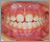 下顎前突症【受け口・混合歯列期】の症例8