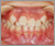 先天性欠如歯【永久歯の先天性欠如】の症例10