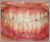下顎前突症【受け口・永久歯列期】の症例7