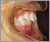 上顎前突症【出っ歯・混合歯列期】の症例20