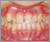 下顎前突症【受け口・永久歯列期】の症例8