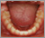 埋伏歯【永久歯列期】の症例6