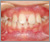 臼歯部交叉咬合【顔面非対称・混合歯列期】の症例1