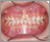 下顎前突症【受け口・混合歯列期】の症例9