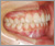 埋伏歯【混合歯列期】の症例6