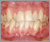 下顎前突症【受け口・永久歯列期】の症例9