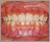 臼歯部交叉咬合【顔面非対称・永久歯列期】の症例7