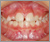 埋伏歯【混合歯列期】の症例7