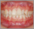 先天性欠如歯【永久歯の先天性欠如】の症例11