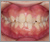 上顎前突症【出っ歯・永久歯列期】の症例27