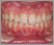 上顎前突症【出っ歯・永久歯列期】の症例29