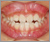 下顎前突症【受け口・混合歯列期】の症例10