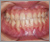 下顎前突症【受け口・永久歯列期】の症例11