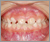 先天性欠如歯【永久歯の先天性欠如】の症例13