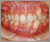 先天性欠如歯【永久歯の先天性欠如】の症例14