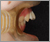 上顎前突症【出っ歯・永久歯列期】の症例31