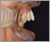上顎前突症【出っ歯・永久歯列期】の症例32