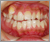 下顎前突症【受け口・永久歯列期】の症例12