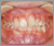 上顎前突症【出っ歯・混合歯列期】の症例25